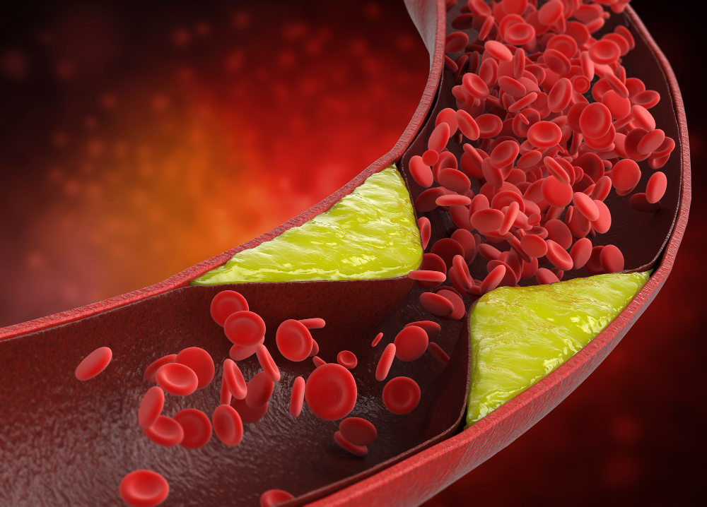 causes of Hematuria